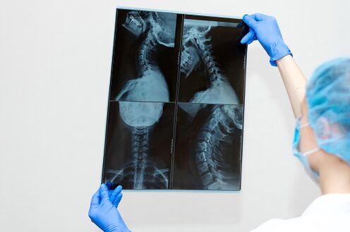 osteohondrozes mugurkaula slimība