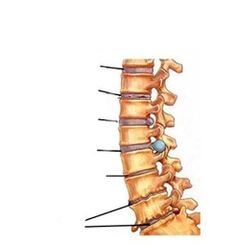 Osteohondrozes attīstības stadijas