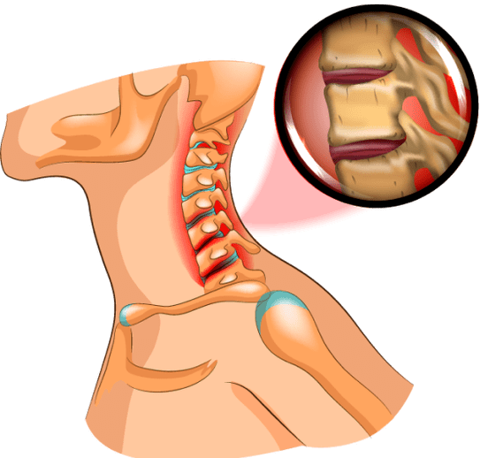 osteohondroze kaklā